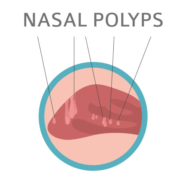 ilustraç�ões, clipart, desenhos animados e ícones de doenças nasais. pólipos nasais causas, diagnóstico e tratamento design infográfico médico - cnidarian