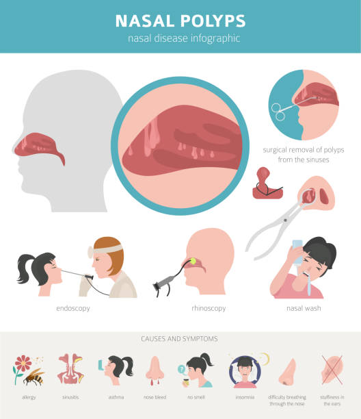 Nasal diseases. Nasal polyps causes, diagnosis and treatment medical infographic design Nasal diseases. Nasal polyps causes, diagnosis and treatment medical infographic design. Vector illustration cnidarian stock illustrations