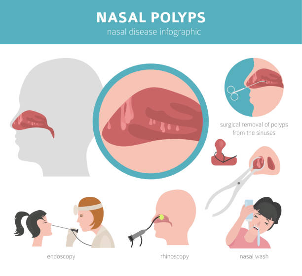 Nasal diseases. Nasal polyps causes, diagnosis and treatment medical infographic design Nasal diseases. Nasal polyps causes, diagnosis and treatment medical infographic design. Vector illustration cnidarian stock illustrations