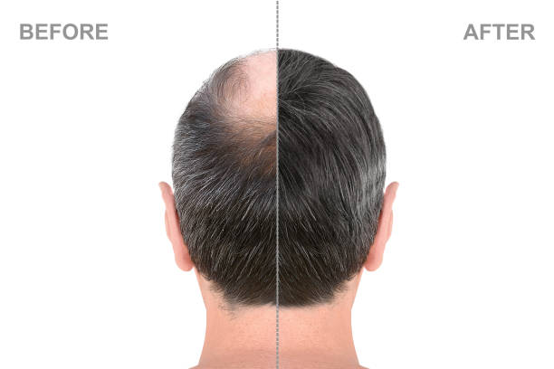 Back view of male head before and after hair extensions Back view of male head before and after hair extensions balding photos stock pictures, royalty-free photos & images
