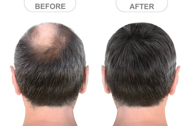 rückansicht des männlichen kopfes vor und nach haarverlängerungen - glatzenbildung stock-fotos und bilder