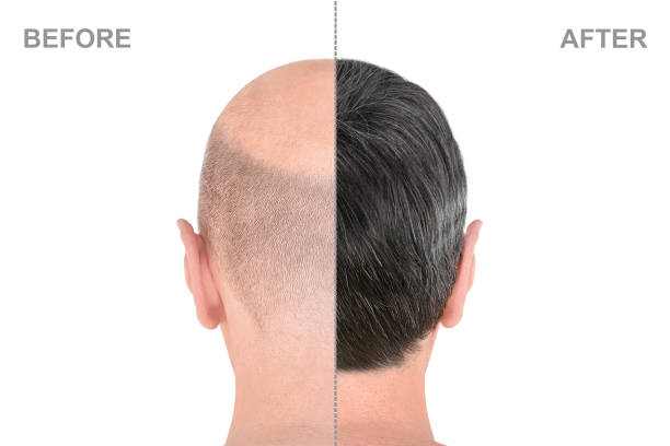 istock Back view of male head before and after hair extensions 1226806520