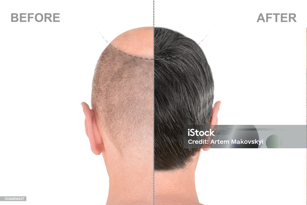 Back View Of Male Head Before And After Hair Extensions Stock Photo - Download Image Now - iStock Back View Of Male Head Before And After Hair Extensions Stock Photo - Download Image Now - iStock