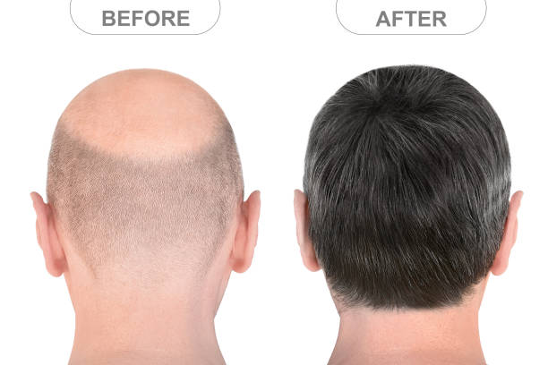 istock Back view of male head before and after hair extensions 1226806546