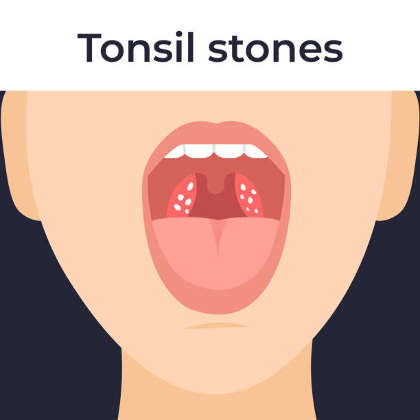 Tonsil stones, woman Tonsil stones in the throat, tonsilloliths. Flat vector cartoon illustration. tonsil stock illustrations