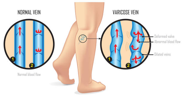 309 Varicose Veins Illustrations & Clip Art - iStock | Varicose veins  treatment, Varicose veins active, Spider veins