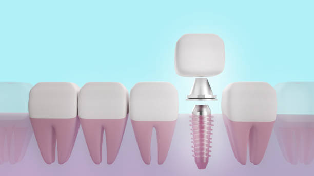 istock Dental implant 3d rendering image for medical content. 1226922014