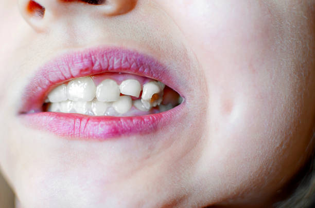 istock Girl has caries on teeth 1226979049