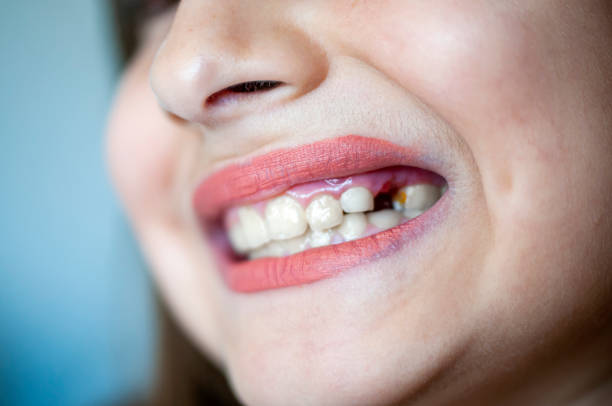istock Girl has caries on teeth 1226979081