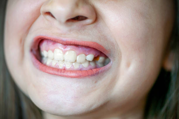 istock Girl has caries on teeth 1226979145