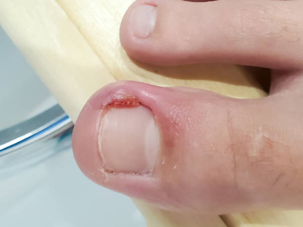 Inflamed Big Toe With An Ingrown Nail And Pus Stock Photo - Download Image Now - Toenail, Fingernail, Inflammation - iStock Inflamed Big Toe With An Ingrown Nail And Pus Stock Photo - Download Image Now - Toenail, Fingernail, Inflammation - iStock