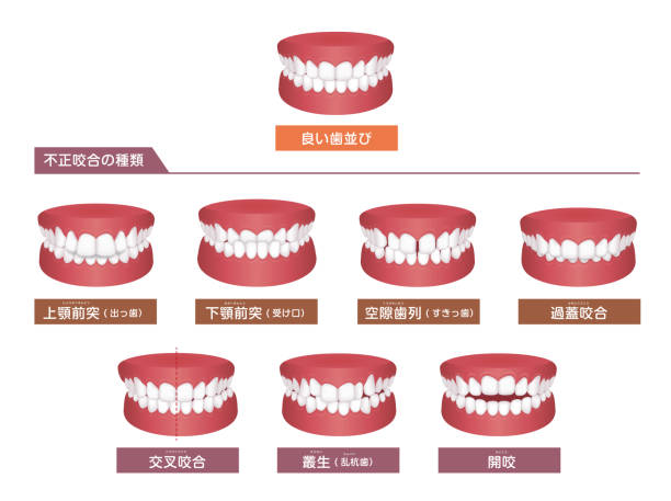 歯トラブル(咬合型)ベクターイラストセット/日本語 - human teeth点のイラスト素材／クリップアート素材／マンガ素材／アイコン素材