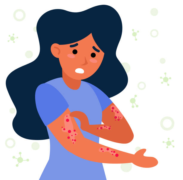 Woman with strong allergy symptoms flat vector illustration Woman with strong allergy symptoms flat vector illustration. Cartoon sad character scratching skin, itching and suffering. Virus disease and eczema concept dry skin stock illustrations
