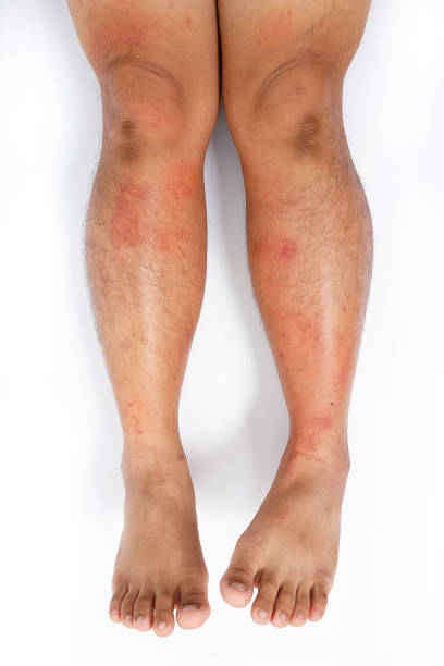 istock Skin Allergy 1227172126