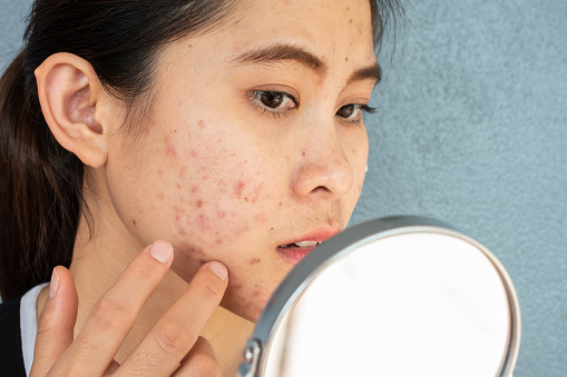 Retrato de la mujer asiática preocuparse por su rostro cuando vio el problema de la inflamación del acné y la cicatriz por el mini espejo. photo