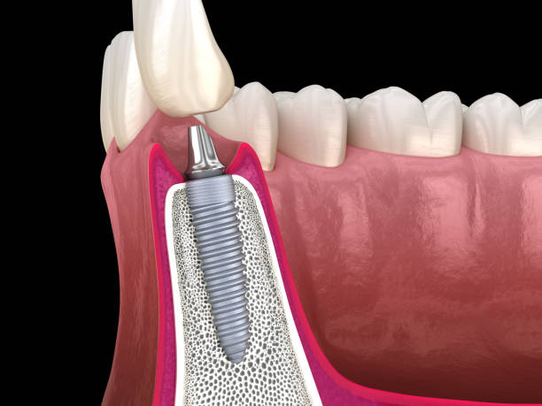 standard abutment, dental implant and ceramic crown. medically accurate tooth 3d illustration. - implantat imagens e fotografias de stock