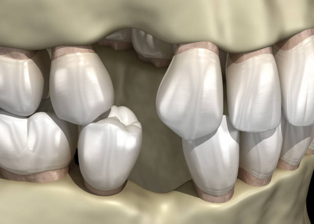 istock Teeth shift deformatiuon after losing teeth. 3D illustration of Popov Godon phenomenon 1227284103
