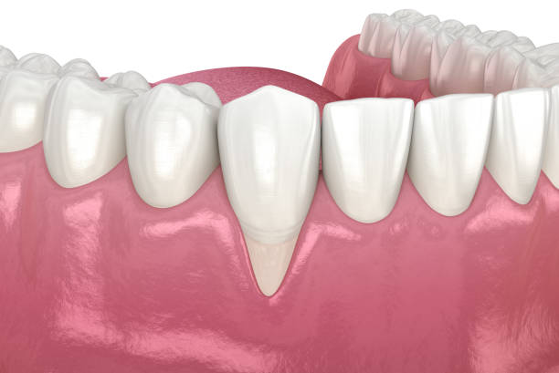 istock Gum Recession. 3D illustration of Dental problem 1227284131