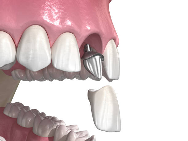 istock Custom abutment, dental implant and ceramic crown. Medically accurate tooth 3D illustration 1227284167