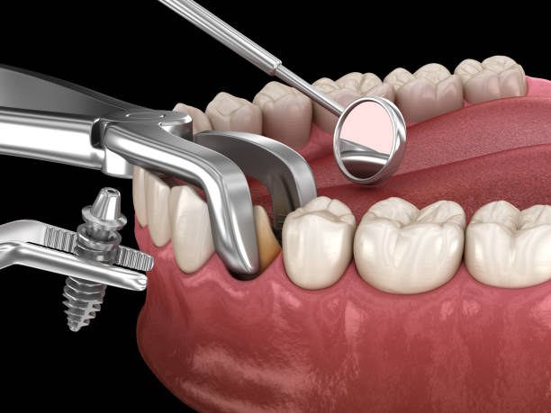 extraction and implantation, complex immediate surgery. medically accurate 3d illustration of dental treatment - implantat imagens e fotografias de stock