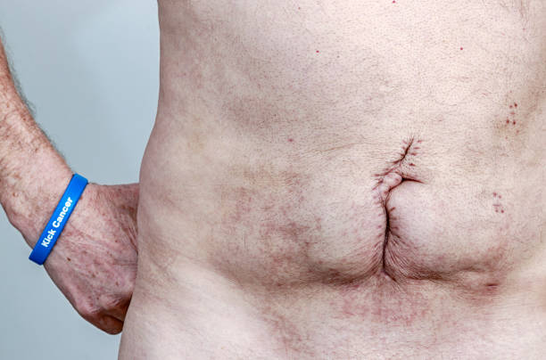 istock Kick Cancer - Abdominal Cancer Surgery Scars Close-Up 1227291087