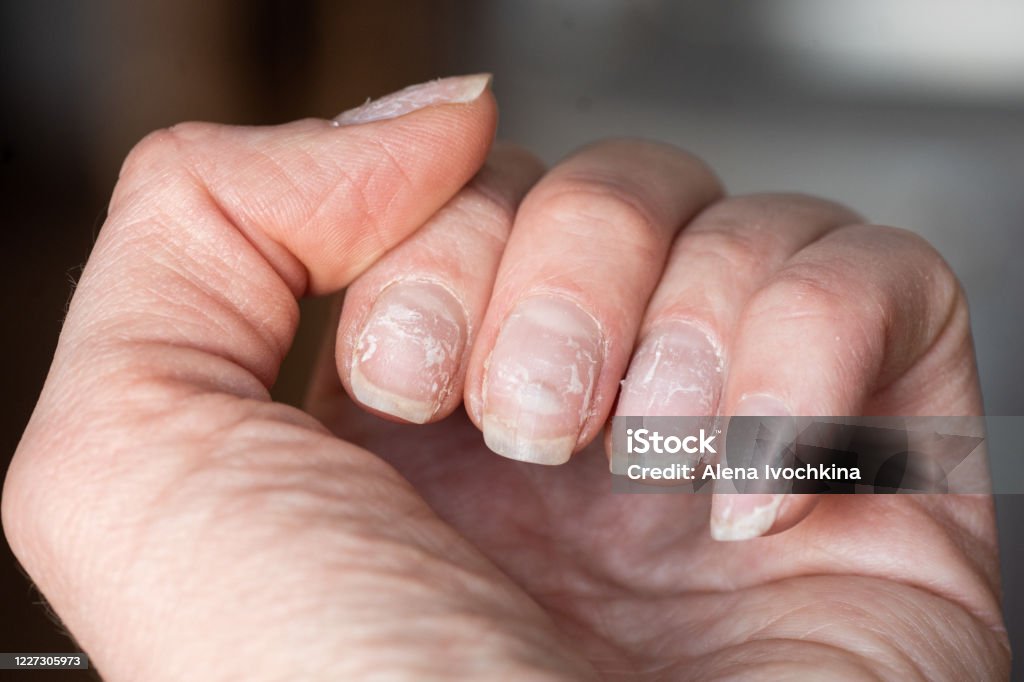 脆い爪のクローズアップ。シェラックまたはゲルポリッシュを使用した後の爪の損傷。爪の皮をむく - 手の爪のロイヤリティフリーストックフォト