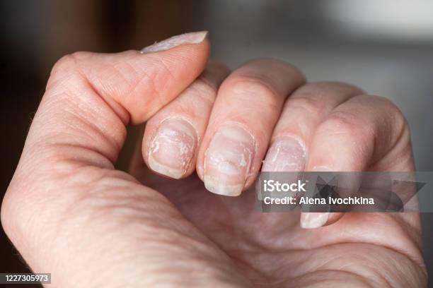 脆い爪のクローズアップシェラックまたはゲルポリッシュを使用した後の爪の損傷爪の皮をむく - 手の爪のストックフォトや画像を多数ご用意 - 手の爪, ダメージ, 壊れた