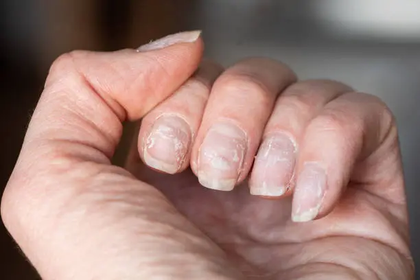 Photo of Close-up of brittle nails. Damage to the nail after using shellac or gel polish. Peeling on the nails