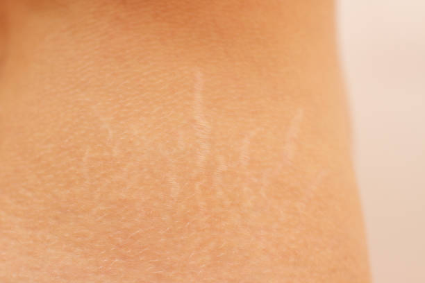 istock Female belly with stretch marks close up 1227354286