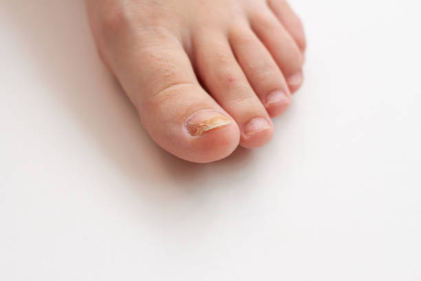 istock foot with nail fungus, skin problem on white background 1227354962