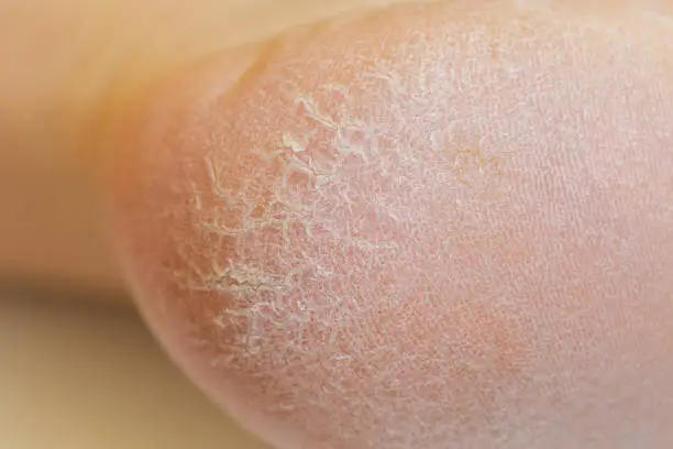 Photo of Closeup of horny skin on a heel