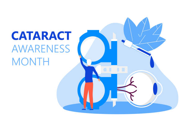 illustrazioni stock, clip art, cartoni animati e icone di tendenza di il mese di sensibilizzazione della cataratta si celebra a giugno. problemi di glaucoma e nefropatia. illustrazione concettuale oftalmologa. controllo della vista con persone minuscole personaggio per il web. - cataratta