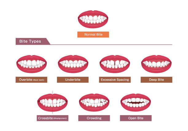 Teeth trouble ( bite type / crooked teeth ) vector illustration set Teeth trouble ( bite type / crooked teeth ) vector illustration set orthodontist stock illustrations