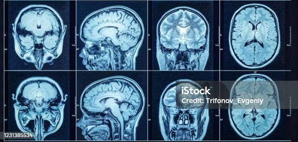 Closeup Of A Ct Scan With Brain Medical Science And Education Mri Brain Background Magnetic Resonance Imaging Stock Photo - Download Image Now