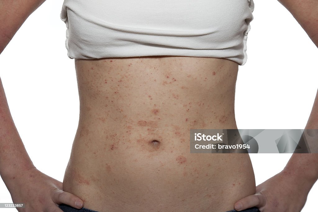 Dermatitis - Foto de stock de Dermatitis atópica libre de derechos