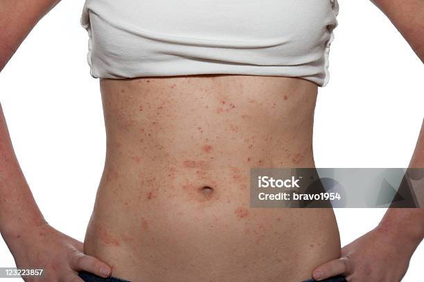 Dermatitis Foto de stock y más banco de imágenes de Dermatitis atópica - Dermatitis atópica, Eczema, Alergia