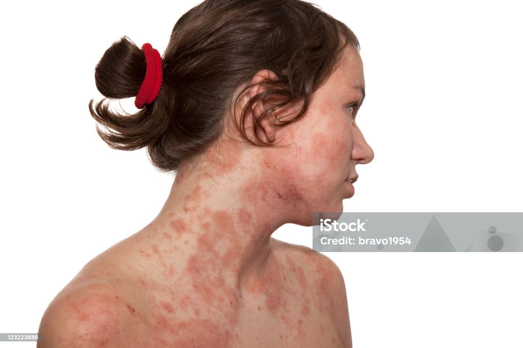 dermatitis atópica - Foto de stock de Eczema libre de derechos