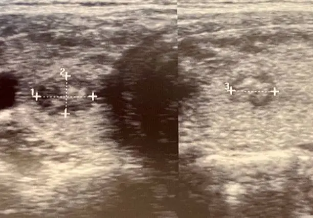 Photo of Ultrasound of human thyroid gland nodule