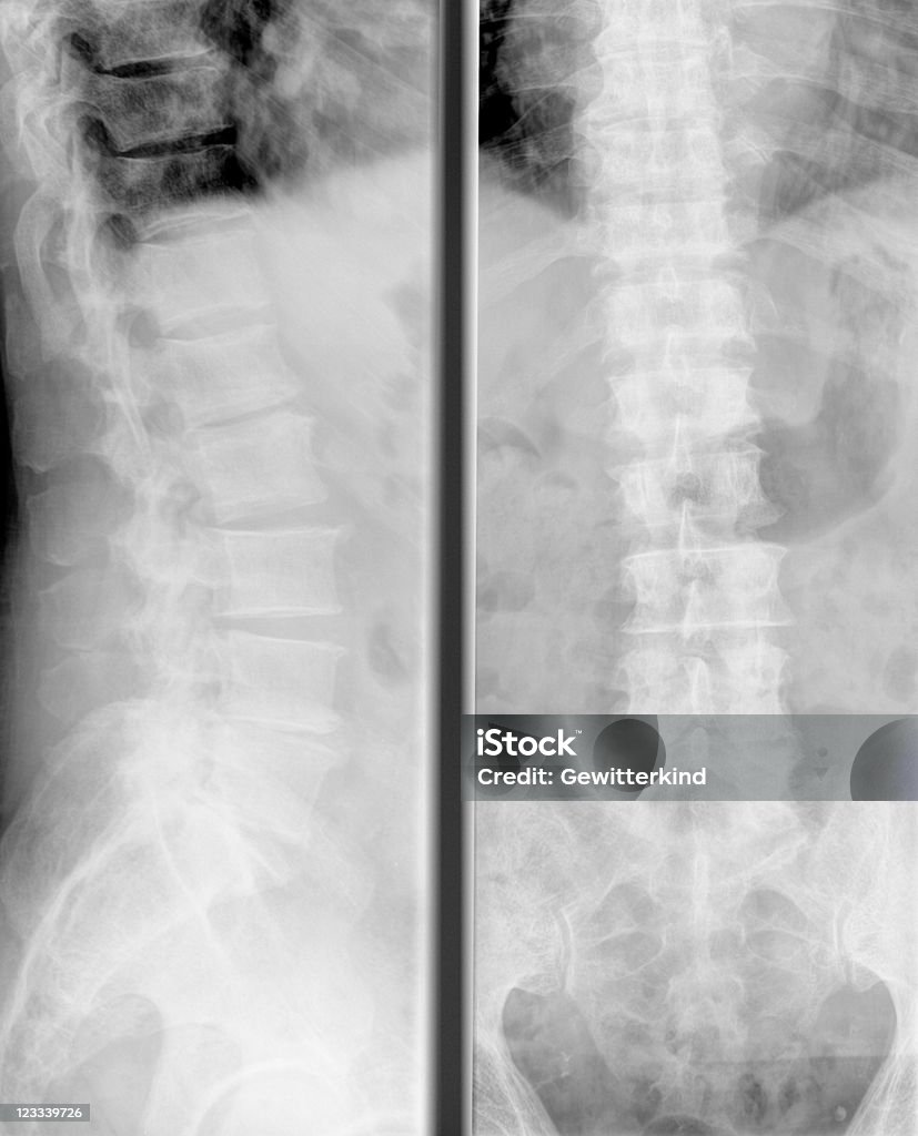X-Ray, la colonne vertébrale - Photo de Tomographie axiale informatisée libre de droits