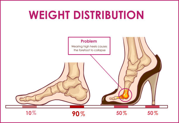Vector illustration of foot pain and weight distribution by wearing high heels vector art illustration