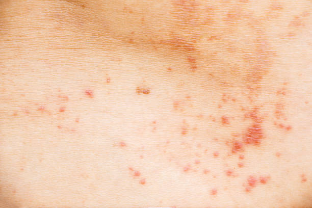 Skin disease prickly heat rash or miliaria on back skin of asian woman. Healthcare skin cause for outdoor work in sunny with hot weather and have sweat. Dermatologist and treatment medication concept. erupción por calor espinoso o miliaria en la piel posterior de la mujer asiática. la piel de la salud causa para el trabajo al aire libre en el clima soleado con calor y tener sudor. concepto de dermatólogo y medicamentos para el tratamiento.