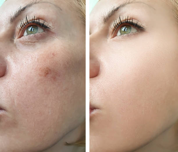 istock woman face wrinkles before and after treatment, pigmentation 1235620772