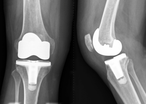 Knee X-ray image after a total knee replacement operation.   The diseased knee joint is replaced with artificial material (White parts).  Frontal view and side-view.
