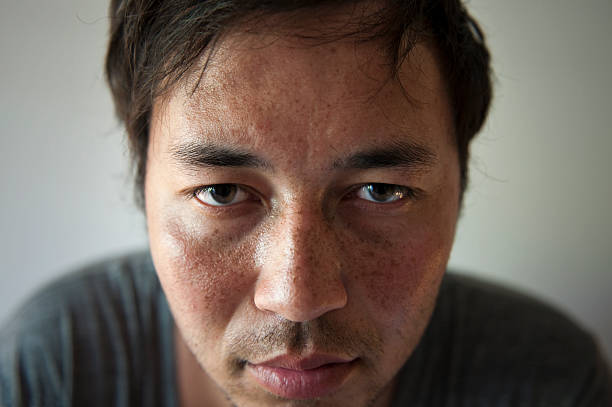istock Tired and Sunburnt Young Man with Freckles. 123688190