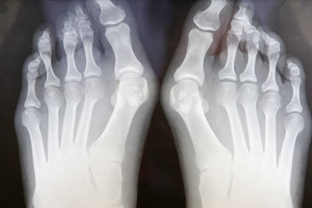 Grunge de raios-X de pés com Bunions - fotografia de stock