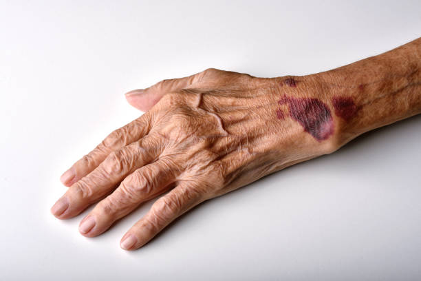 ferita da lividi sulla pelle del braccio del polso degli anziani, incidente di lesioni nelle cadute nell'anziano. - violent wind foto e immagini stock