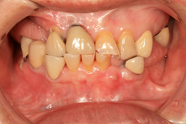 Periodontitis ストックフォト