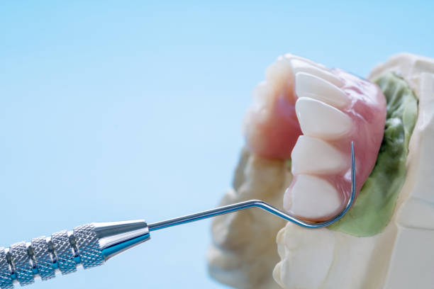 istock Dental implant work is completed and ready to use. 1238763270