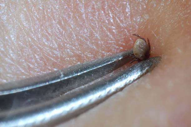 Super close up of sucking tick (Ixodes ricinus) removal with steel tweezers on human skin. Adult ticks feed on large mammals  for 6–13 days, before dropping off. stock photo