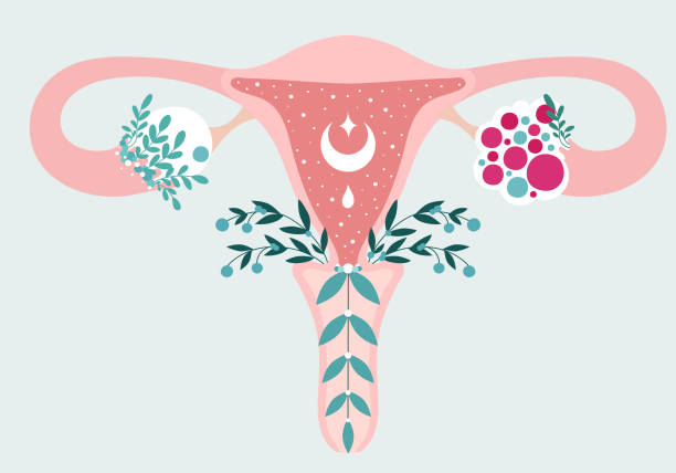 Women health - Floral Infographic of Polycystic ovary syndrome. Patient-friendly scheme of PCOS, Multifollicular cyst. Gynecological problems - Neutral medical diagram uterus and uterine appendages PCOS - Anatomical scheme of Uterus in flowers. Polycystic ovary syndrome - Diagram of reproductive system. Women health human fertility stock illustrations